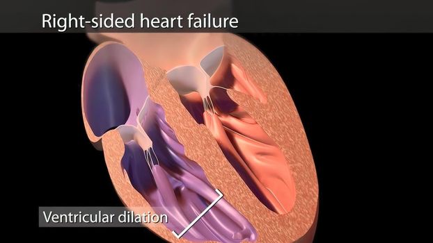 illustration Congestive Heart Failure