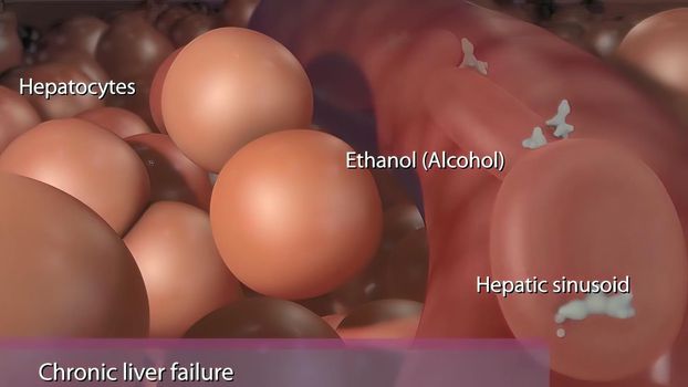 Chronic liver failure caused by the hepatitis B virus.