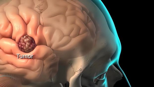 A brain tumor is a collection or mass of abnormal cells in your brain.
