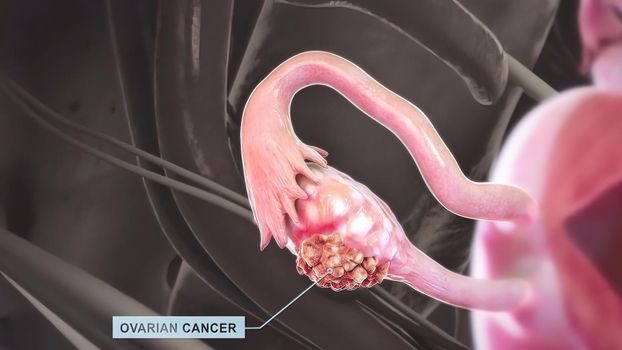 Ovarian cancer is a disease in which cells in the ovaries multiply and grow abnormally.