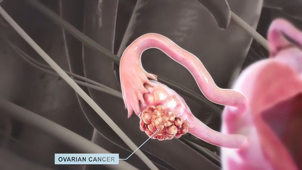 Ovarian cancer is a disease in which cells in the ovaries multiply and grow abnormally.