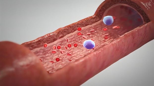 Clogged Artery with platelets and cholesterol plaque, concept for health risk for obesity