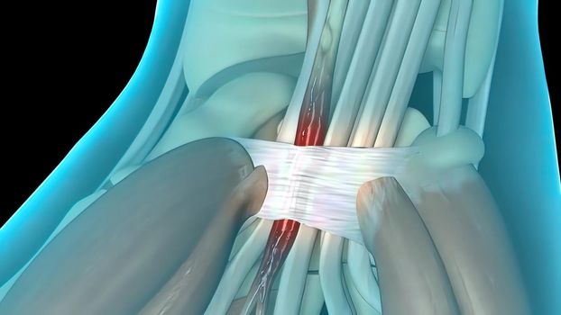 Carpal tunnel syndrome (CTS), numbness, tingling and pain condition in wrist