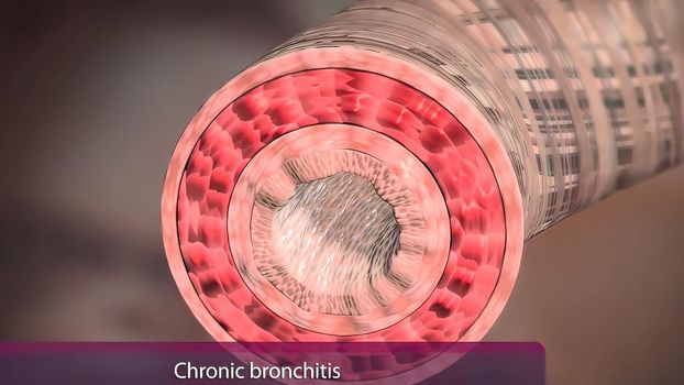 It is caused by ecessive mucus production and secretion in chronic bronchitis.
