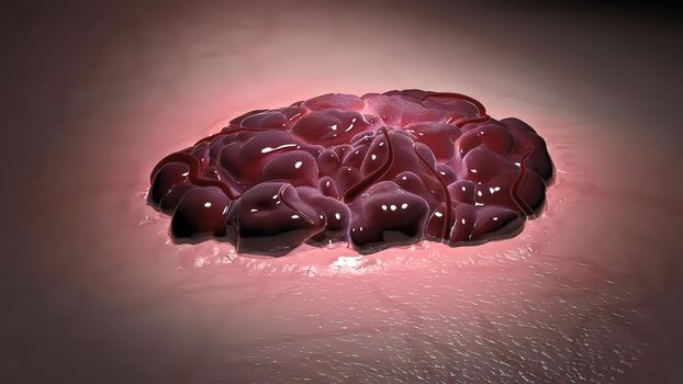illustrationof Vascular birthmarks cell 3D medical illustration