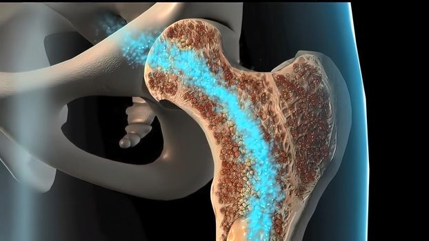 Development of human bone osteoporosis spongy tissue from normal to sick