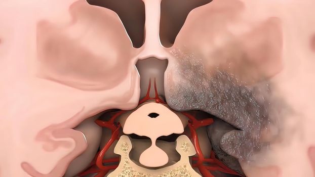 3D medical illustration of brain injury