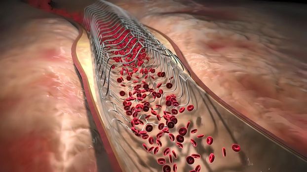 Hemoglobin cells flowing through a blocked Artery causing arteriosclerosis disease.