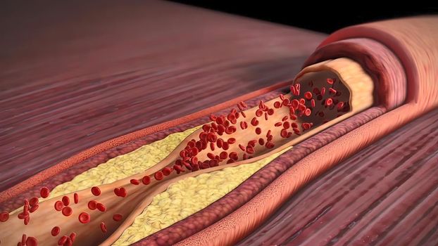 cholesterol plaque, atherosclerosis and heart attack