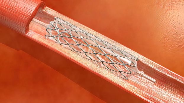Hemoglobin cells flowing through a blocked Artery causing arteriosclerosis disease.