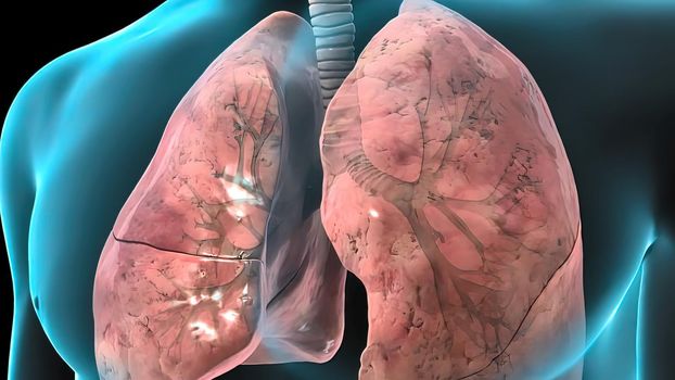 Damaged sick lungs. 3D render illustration for respiratory problems, cancer medical or health problems.