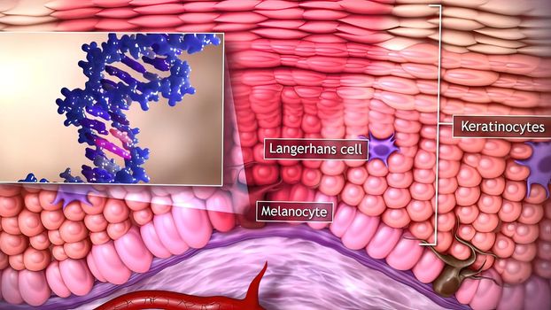 3d medical illustration of skin cancer: Squamous cell carcinoma, basal cell cancer