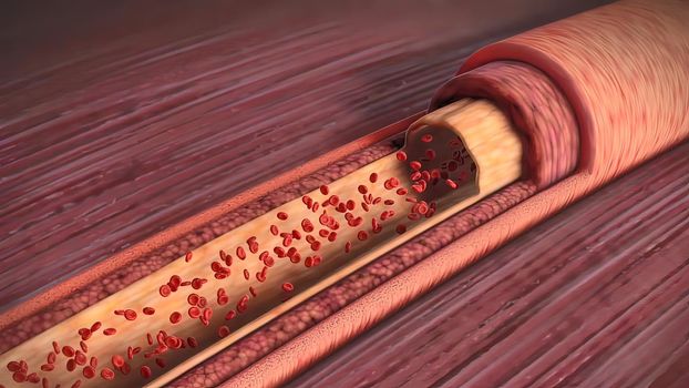 cholesterol plaque, atherosclerosis and heart attack