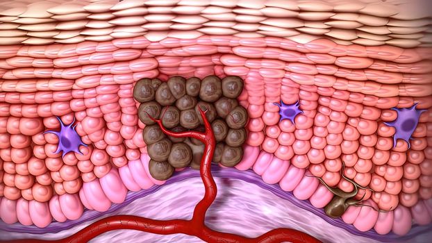 3d medical illustration of skin cancer: Squamous cell carcinoma, basal cell cancer