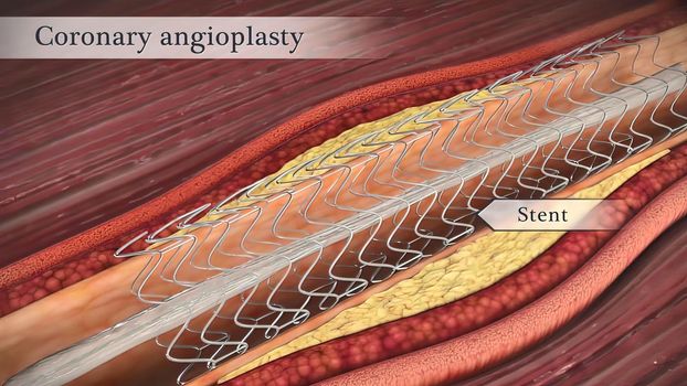 Coronary angioplasty opens narrowed coronary arteries.