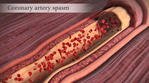 Coronary artery spasm is a brief, sudden narrowing of one of these arteries.