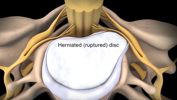 herniated (ruptured) disc