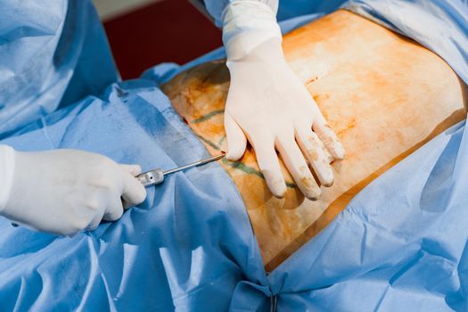 Close-up liposuction of abdomen. Surgeon does abdominoplasty for woman. Plastical operation in medical clinic