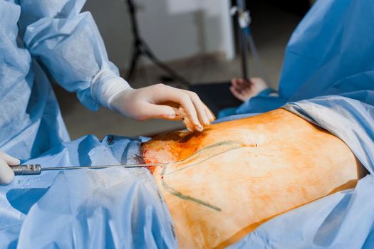 Close-up liposuction of abdomen. Surgeon does abdominoplasty for woman. Plastical operation in medical clinic