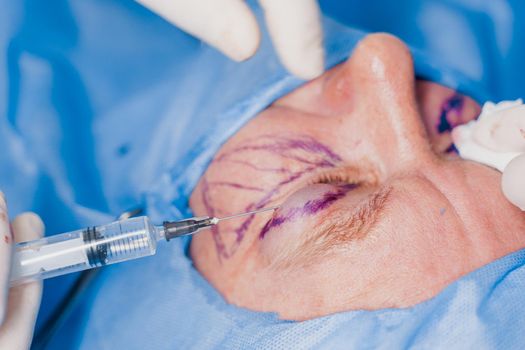 Close-up anesthesia before blepharoplasty and lipofilling plastic surgery operation for modifying the eye region of the face in medical clinic.