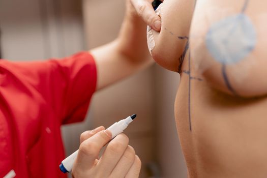 Drawing a marking line on the chest of a young girl. Breast augmentation surgery markup.