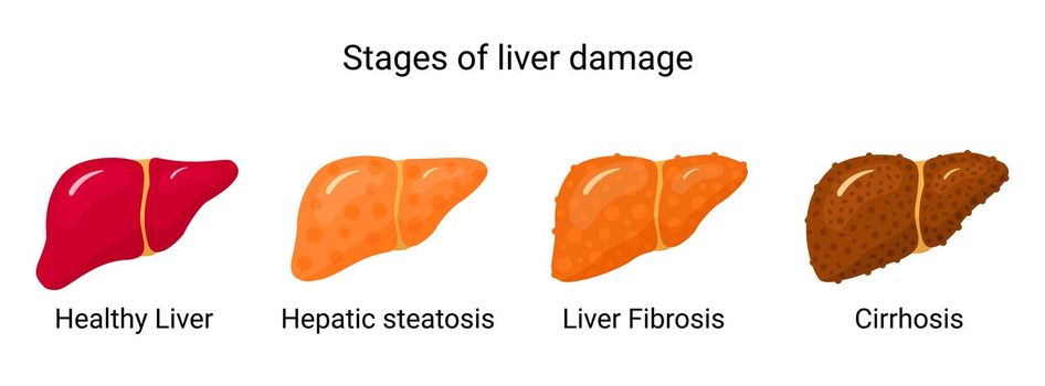 Stages of liver damage. Vector illustration liver conditions in flat style	