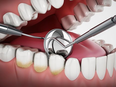 3D illustration showing dentist tools and dental plaque on model. 3D illustration