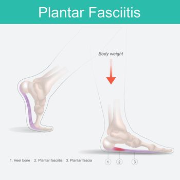 Plantar Fasciitis. Illustration human foot anatomy explain on symptom plantar fasciitis.
