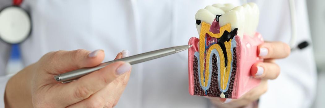 Doctor showing carious cavity with ballpoint pen on plastic artificial tooth model closeup