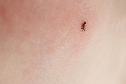 Dangerous insect tick. Ixodes ricinus tick sucking on human skin. A bloated parasite has bitten a man. Pink irritated epidermis. Encephalitis infection, Lyme disease.