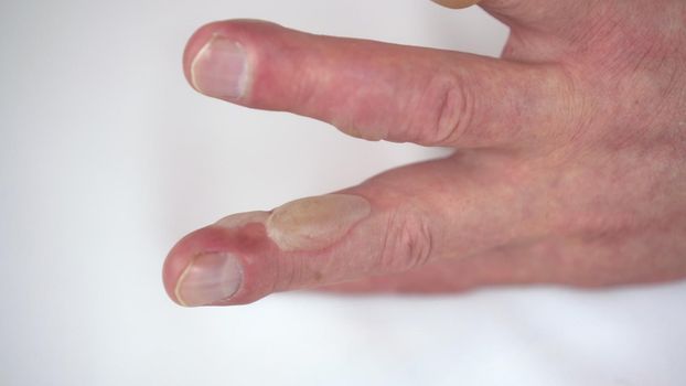 Close-up - burn of a man's hand with hot water of the second degree. The skin is swollen with blisters.