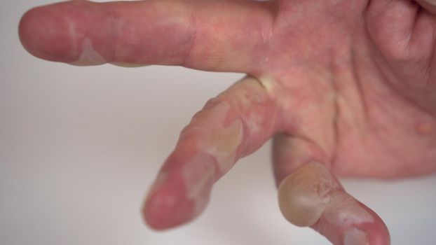 Close-up - burn of a man's hand with hot water of the second degree. The skin is swollen with blisters.