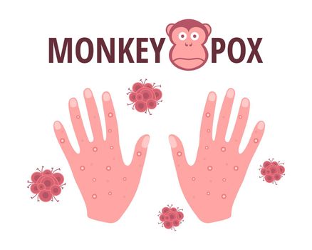 Monkey pox virus. Vector design with skin rash on the hands, symptom of an infectious disease