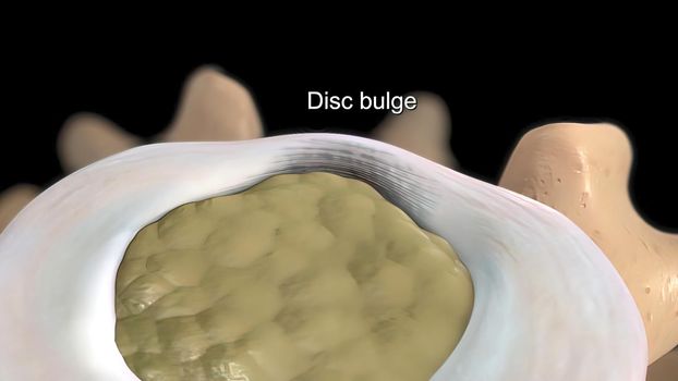 Disc deformation in the spinal system