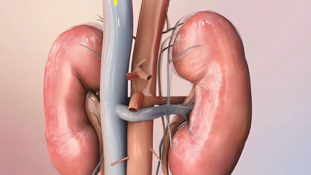 Damage to the kidneys as a result of high potassium levels in the blood.