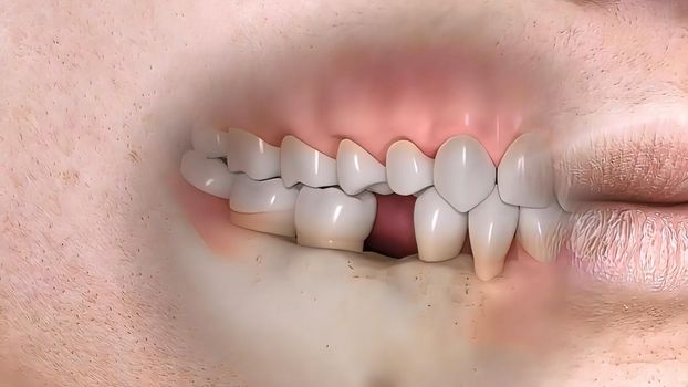 Disruption of teeth structure Realistic medical animated