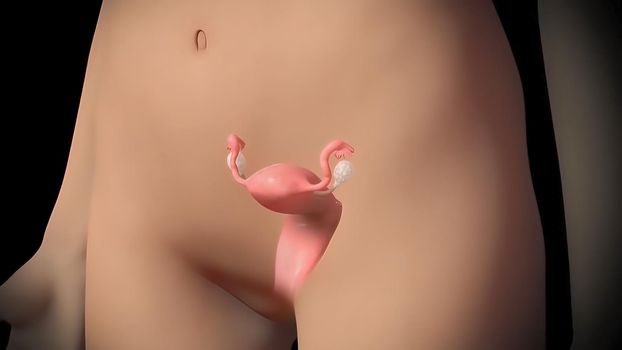 Uterus with endometriosis . Fertility, human anatomy, female reproductive system.