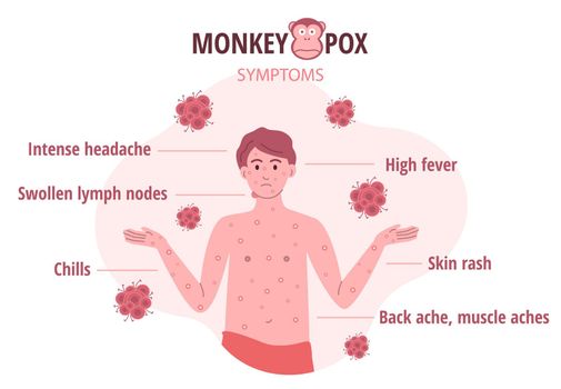 Monkey pox outbreak. Infographics of virus symptoms in humans. Vector illustration for informing people about an infectious disease