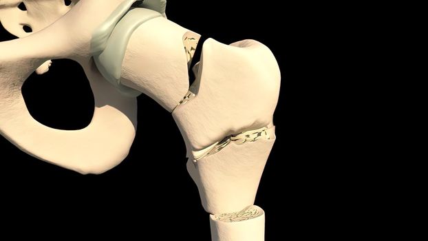 A femur fracture is a break, crack, or crush injury of the thigh bone.