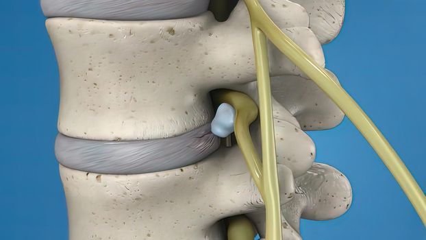 3D illustration of the spinal cord on blue background. Endoscopic lumbar discectomy
