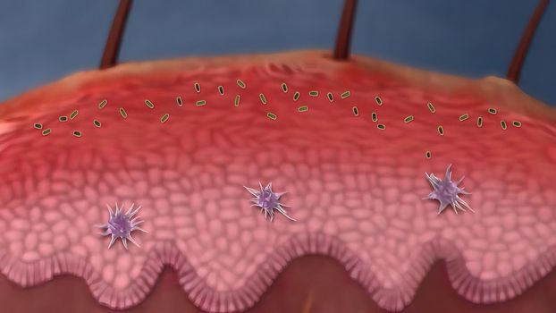 The attack of airborne bacteria on the skin wound and the activation of the immune system 3D illustration