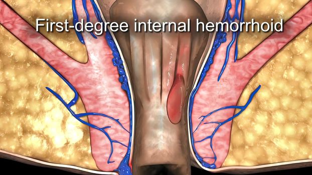 A first degree internal hemorrhoid bulges into the anal canal during bowel movements.