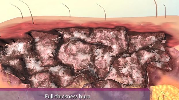 Full thickness burns are third degree burns.