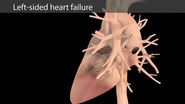 3D Animated right-sided heart failure - beating heart