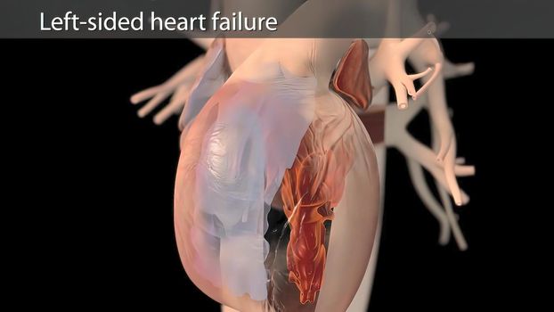 3D Animated right-sided heart failure - beating heart