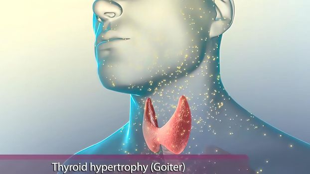 Hyperthyroidism is when the thyroid gland produces more thyroid hormone than your body needs. 3d illustration