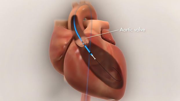 heart stent insertion process