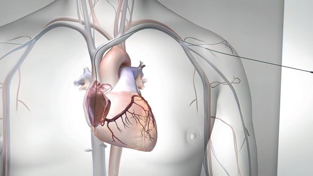 A surgical procedure to reduce the risk of death, Coronary Artery Bypass Graft