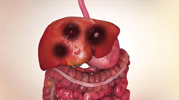 liver and colon cancer 3d medical