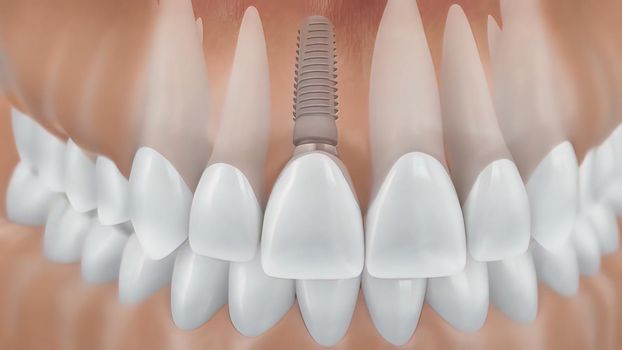 Dental implant surgery.